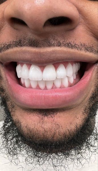 Teeth whitening cream